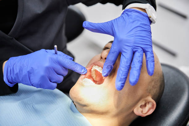 Best Knocked-Out Tooth (Avulsed Tooth) Treatment in Tangerine, FL